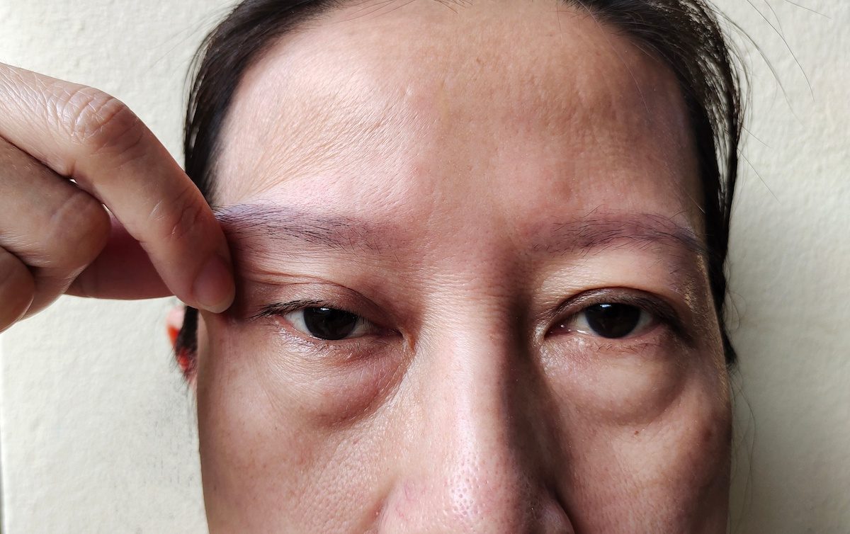 ¿Puede haber espasmo hemifacial por estrés?